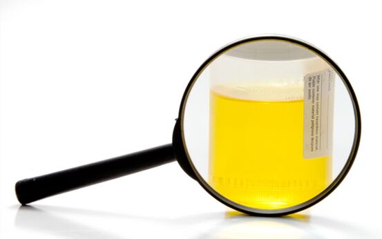 Analyse d'urine pour diagnostiquer la schistosomiase